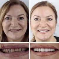 (Affordable beauty for all🧏♀️🧏♂️) -- Have you ever been embarrassed by your smile or crooked teeth? Smileasego™ -- Advanced, fully personalized set of braces🦷