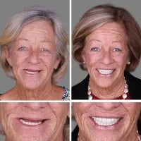 (Affordable beauty for all🧏♀️🧏♂️) -- Have you ever been embarrassed by your smile or crooked teeth? Smileasego™ -- Advanced, fully personalized set of braces🦷