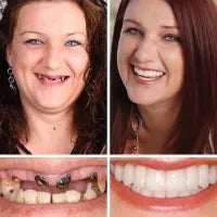 (Affordable beauty for all🧏♀️🧏♂️) -- Have you ever been embarrassed by your smile or crooked teeth? Smileasego™ -- Advanced, fully personalized set of braces🦷