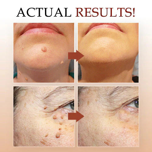 LOVILDS™ Tags & Moles Remover (Buy 1 Get 1 Free🔥🔥)