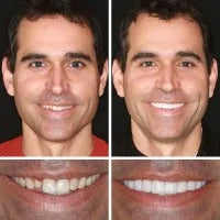 (Affordable beauty for all🧏‍♀️🧏‍♂️) -- Have you ever been embarrassed by your smile or crooked teeth? Smileasego™ -- Advanced, fully personalized set of braces🦷